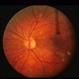 CMV Retinitis