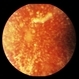 Asteroid Hyalosis