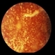 Asteroid Hyalosis