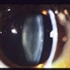 Dilated Slit Lamp Exam