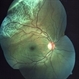 Rhegmatogenous Retinal Detachment Rhegmatogenous Retinal Detachment