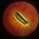 Intraocular Foreign Body Intraocular Foreign Body