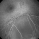 Juvenile X-linked Retinoschisis Juvenile X-linked Retinoschisis