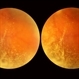 Asteroid Hyalosis, In Stereo Asteroid Hyalosis, In Stereo