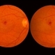 Subfoveal Choroidal Neovascularization, In Stereo Subfoveal Choroidal Neovascularization, In Stereo