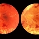 Proliferative Diabetic Retinopathy, In Stereo Proliferative Diabetic Retinopathy, In Stereo