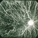 Choroideremia Choroideremia