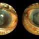 Choroidal Detachment, In Stereo Choroidal Detachment, In Stereo