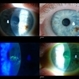 Keratitis