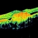 Heredomacular Degeneration Heredomacular Degeneration