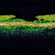 Lamellar Macular Hole Lamellar Macular Hole