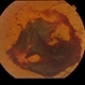 Proliferative Diabetic Retinopathy with Subhyaloid hemorrhage Proliferative Diabetic Retinopathy with Subhyaloid hemorrhage