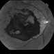 Proliferative Diabetic Retinopathy with Subhyaloid hemorrhage Proliferative Diabetic Retinopathy with Subhyaloid hemorrhage
