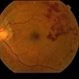 Proliferative Diabetic Retinopathy with Subhyaloid hemorrhage Proliferative Diabetic Retinopathy with Subhyaloid hemorrhage