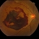 Proliferative Diabetic Retinopathy with Subhyaloid Hemorrhage Proliferative Diabetic Retinopathy with Subhyaloid Hemorrhage