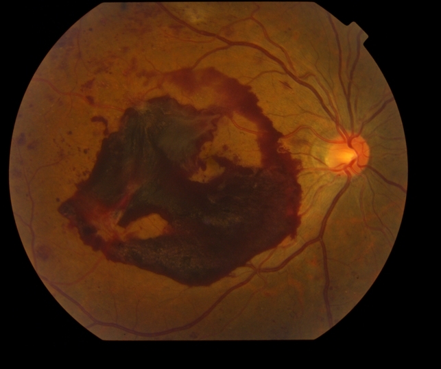 Proliferative Diabetic Retinopathy With Subhyaloid Hemorrhage Retina proliferative-diabetic-retinopathy-with-subhyaloid-hemorrhage-retina