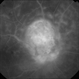 Late Phase FA of Optic Disc Capillary Hemangioblastoma Late Phase FA of Optic Disc Capillary Hemangioblastoma