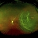 Retinal Detachment Pre-Op Retinal Detachment Pre-Op