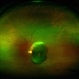 Massive Submacular Hemorrhage