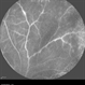 Occlusive Vasculitis Occlusive Vasculitis