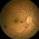 Leukemic Retinopathy Leukemic Retinopathy