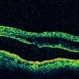 Macular Detachment from Multiple Myeloma Macular Detachment from Multiple Myeloma