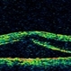 Macular Detachment from Multiple Myeloma Macular Detachment from Multiple Myeloma