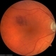 Ruptured Macroaneurysm OD Ruptured Macroaneurysm OD