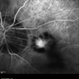 Myopic Choroidal Neovascularization Myopic Choroidal Neovascularization