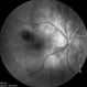 Ruptured Macroaneurysm Ruptured Macroaneurysm