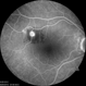 Ruptured Macroaneurysm Ruptured Macroaneurysm