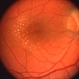 Neuroretinitis Neuroretinitis