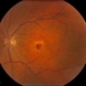 Retinal Macroaneurysm