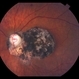Macular CHRPE