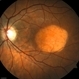 Macular Choroidal Osteoma Macular Choroidal Osteoma