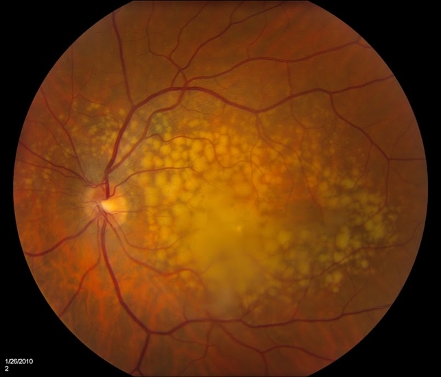 Macular drusen retina image bank