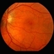 Macular Hole Macular Hole