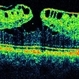 Lamellar Macular Hole Lamellar Macular Hole
