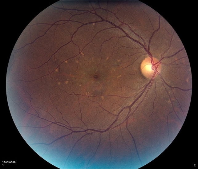 Macular Star - Retina Image Bank