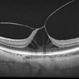 Macular Traction (Grayscale)