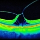 Macular Traction (Color)