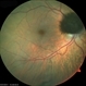 Melanocytoma Melanocytoma