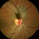 Melanocytoma Melanocytoma