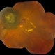 Melanoma With Radiation Retinopathy