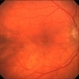 Mild VMT plus drusen Mild VMT plus drusen