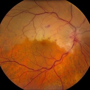 Central Retinal Artery Occlusion - Retina Image Bank