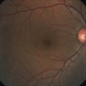Myelinated Nerve FibersTtemporal to the Macula