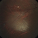Myelinated Nerve Fibers Temporal to the Macula