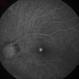 Myopic Choroidal Neovascularization Myopic Choroidal Neovascularization