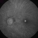 Myopic Choroidal Neovascularization Myopic Choroidal Neovascularization